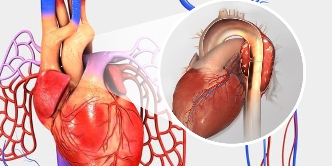 Descubra Mais sobre Aneurismas Cardíacos: Uma Condição Importante para a Saúde do Coração